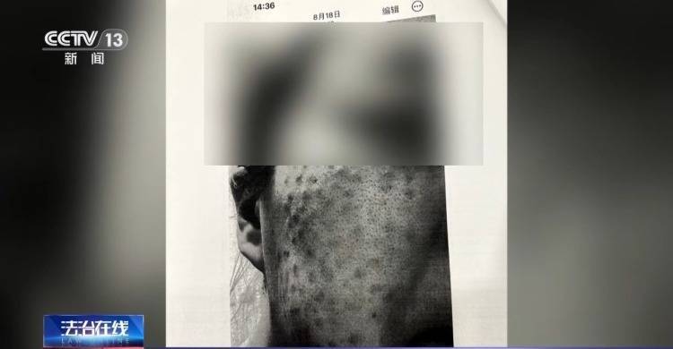 皇冠信用网代理占成_打美容针竟致十级伤残皇冠信用网代理占成！在医生家中做医美 出了事谁负责？